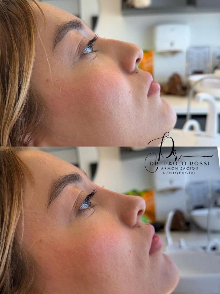rinomodelacion con acido hialuronico 👃🏻pequeños cambios, grandes resultados ✨rinomodelación co
