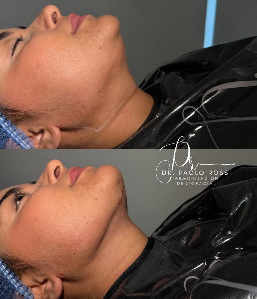 ✨ antes y después de una lipopapada con marcación mandibular ✨redefinición del contorno facial,